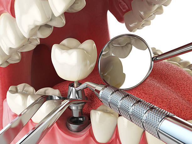 Best Emergency Root Canal Treatment in Egypt Lake Leto, FL